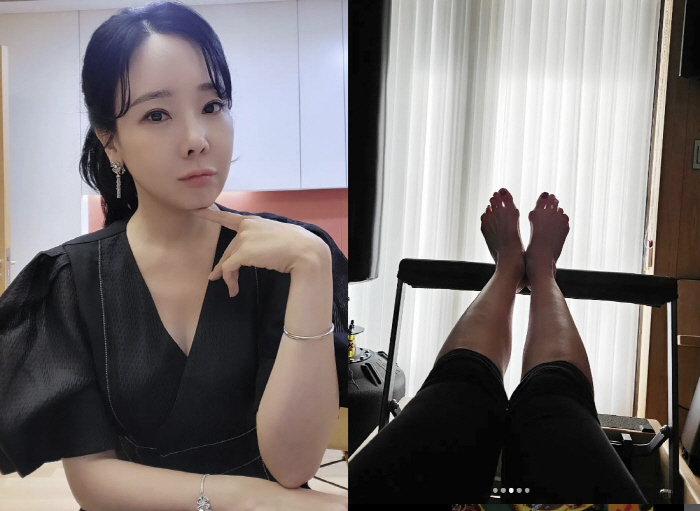 '백종원♥' 소유진, 무지외반증 발 공개...심각한 모양으로 변형 "수술…