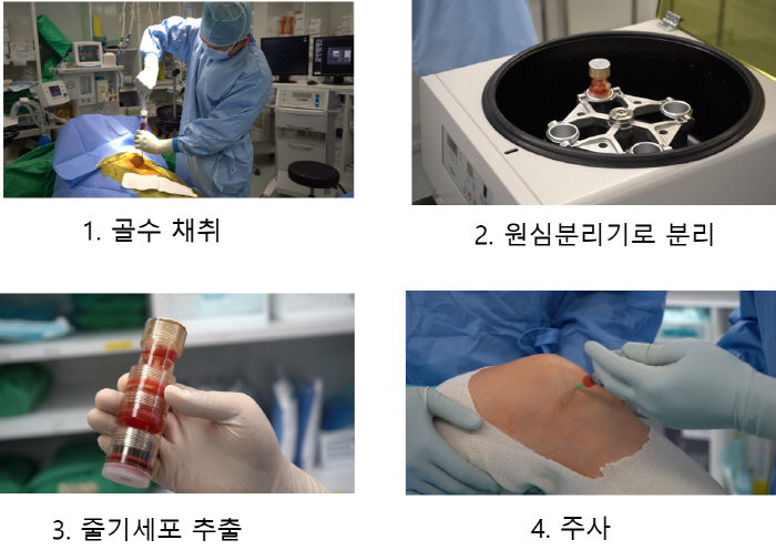 서울예스병원 '자가골수줄기세포 주사치료' 도입