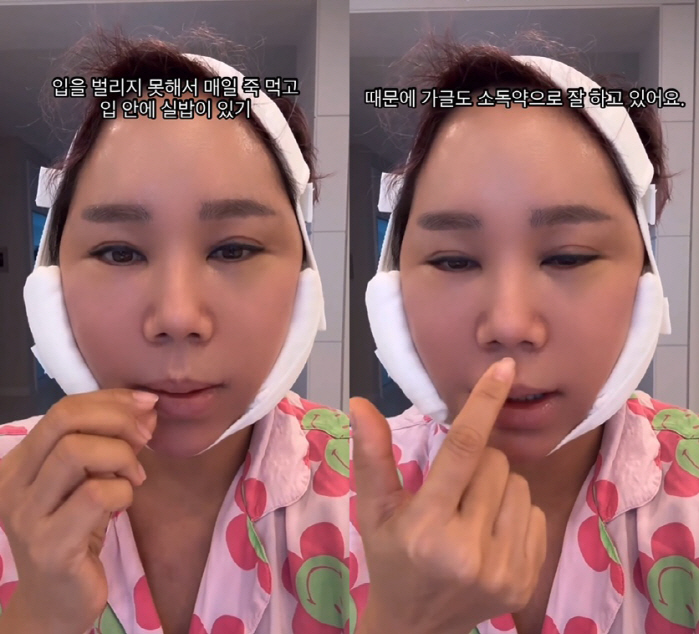 '강원래♥' 김송, 광대수술 후 여전히 퉁퉁 부은 얼굴 "입 벌릴 수 없…