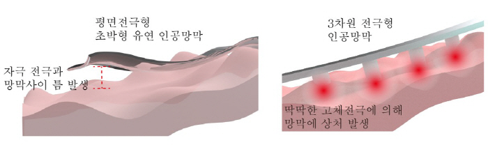 실명 환자 시력 회복 돕는 소프트 인공망막 개발