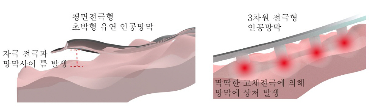 실명 환자 시력 회복 돕는 소프트 인공망막 개발