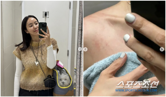 박지윤, 전국민 5%만 고생한다는 피부병으로 고생…"피 맺히도록 긁는 것…