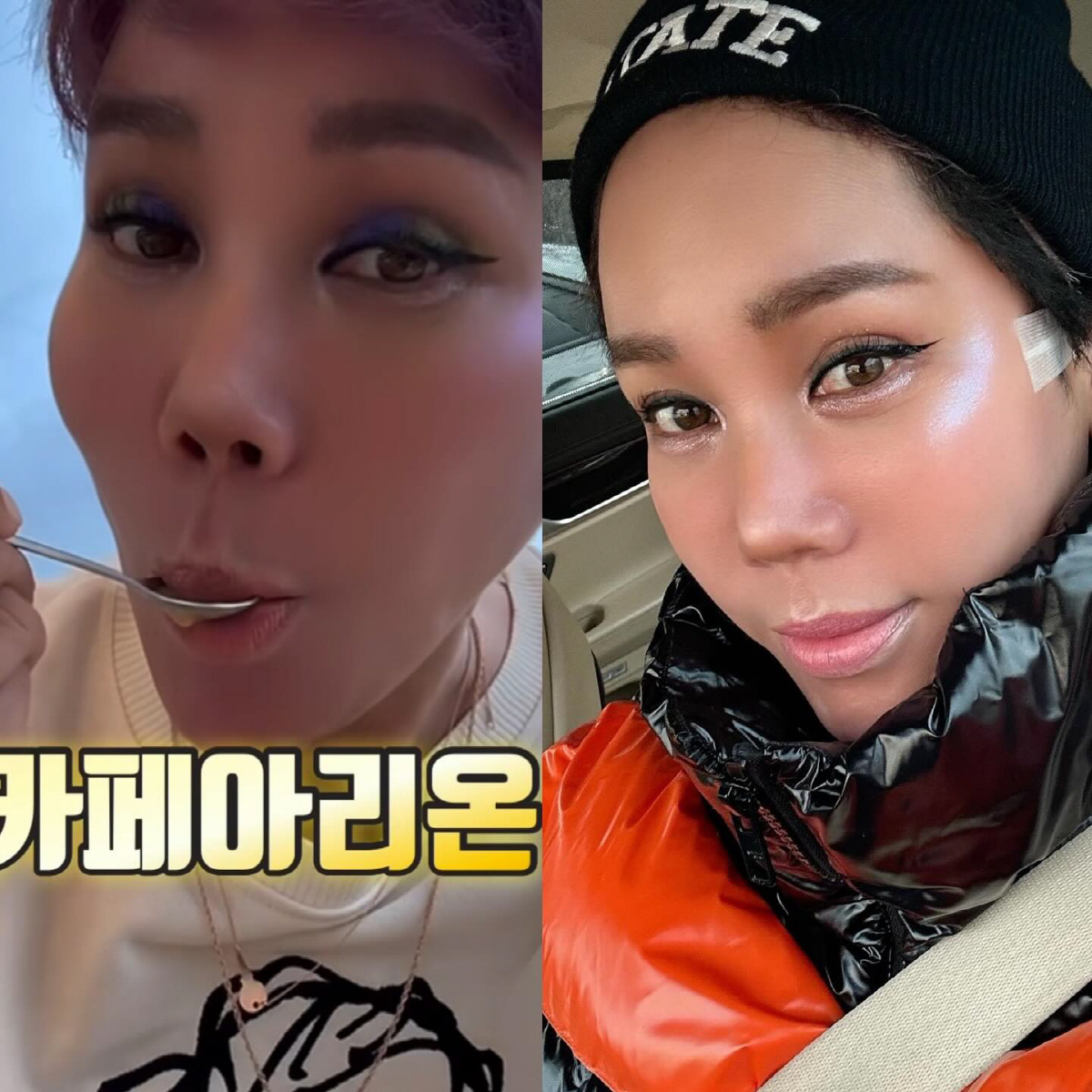김송, 광대 수술 '비포&애프터' 자신감 "만족도 100%..옆모습 마음…
