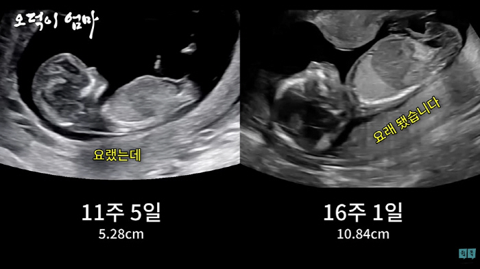 '김용건 며느리' 황보라, 패딩 입고도 'D라인' 볼록..."최악 컨디션…