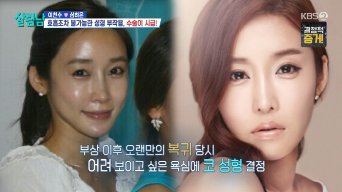 '이천수♥' 심하은, 성형 부작용 고백 "3개월간 코 재수술 3번, 호흡…