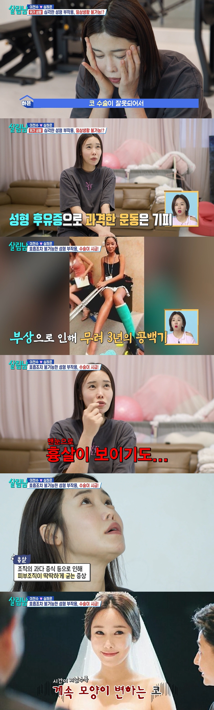 심하은, 3번 코 수술+애굣살 부작용 심각..이천수 "징그럽다" 막말에 …