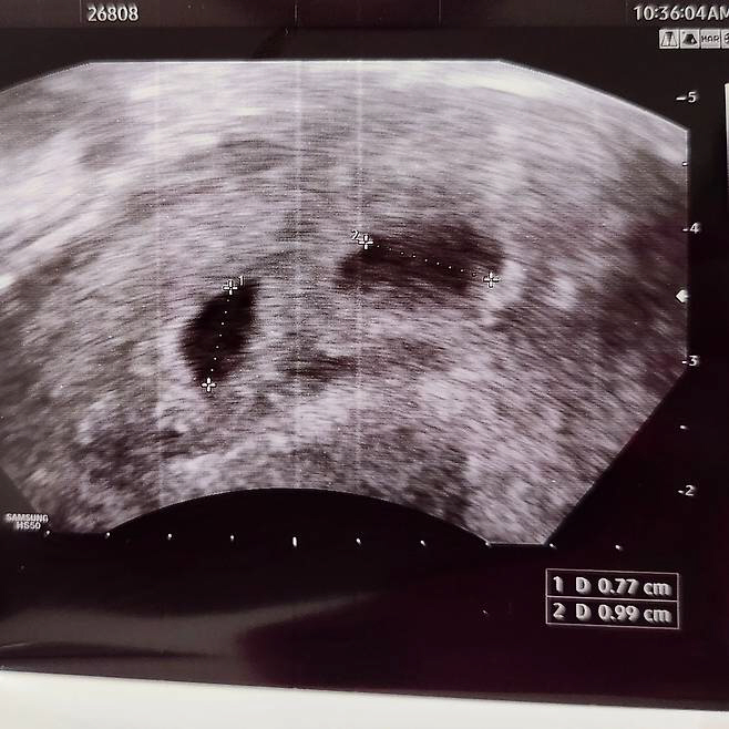 '야구여신' 정인영, ♥윤석현과 재혼 1년만 쌍둥이 임신…"고위험 산모지…