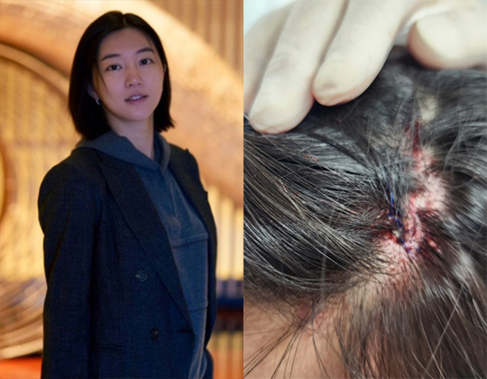 하연주, 드라마 촬영 중 머리 찢어지는 부상 "결국 피를 봐..흉 생겨 …