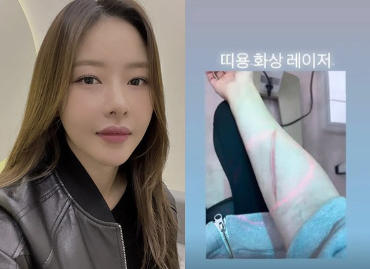 박하나, 팔뚝에 커다란 '화상 자국'…흉터 어쩌나
