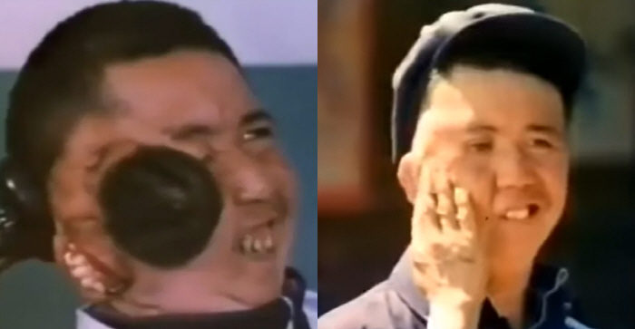 “뺨에 움직이는 기생 태아”..두 개의 머리를 가진 남성