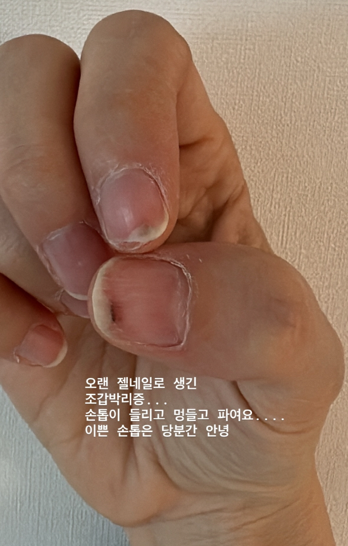 아이비, 조갑박리증 고백..."멍들고 피부 파이고" 고통 호소