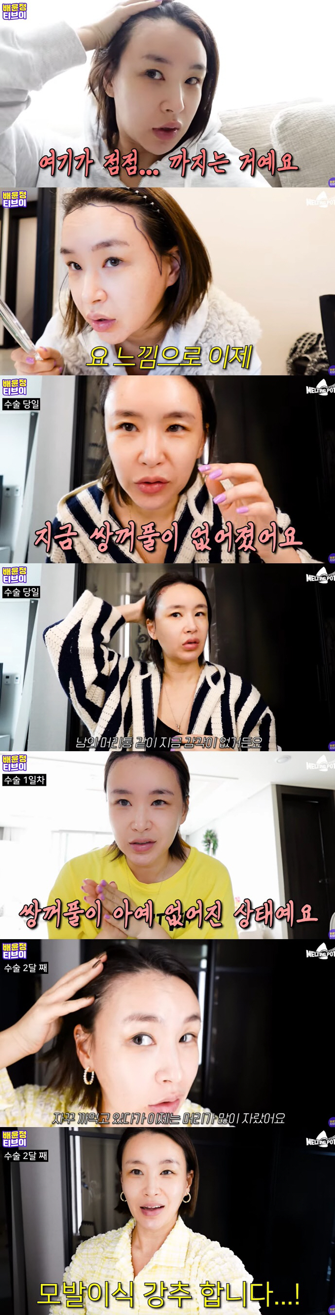 배윤정, 모발이식 리얼 후기 "너무 부어서 쌍꺼풀 실종돼" ('배윤정TV…