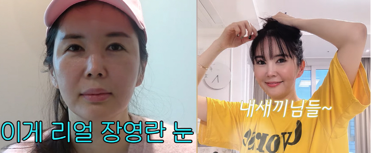 장영란, ★ 최초 성형 '비포&애프터' 공개 "25년만 6번째 수술, 고…