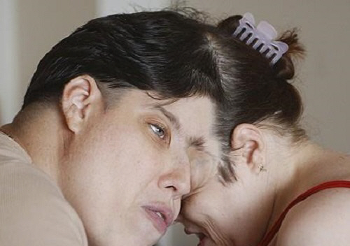 "서로 떠날 수 없는 존재" 세계 최고령 샴쌍둥이 남매, 62세에 함께 …