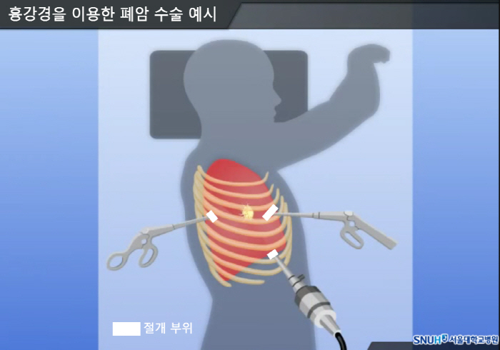 [폐암 Q&A] '가족력'은 상대적으로 낮아…환자 대다수 '4기' 치료는…