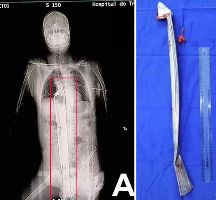 1미터 길이 공사장 쇠막대 몸 관통 '기적 생존'