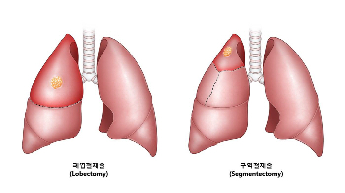 "AI로 구역절제술 받은 비소세포폐암 환자 예후 예측 가능"