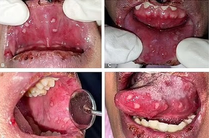 전자담배 1년 흡연 여성 입안 '끔찍'…헤르페스인 줄 알았는데