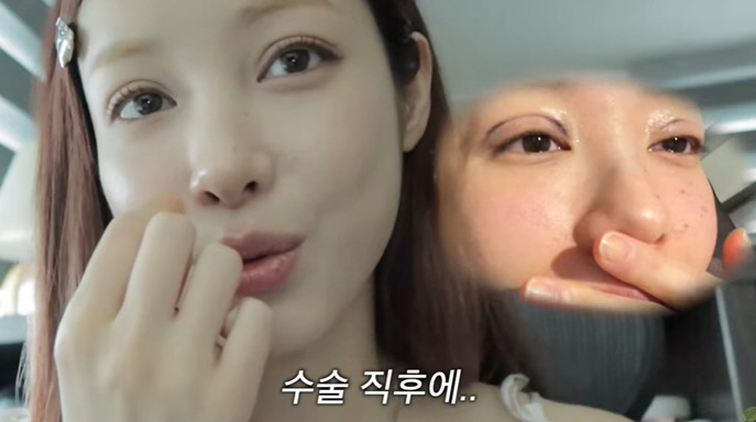 '가슴·윤곽 성형' 유깻잎, 쌍꺼풀 수술도 받았다 "이제 이마로 눈 안 …