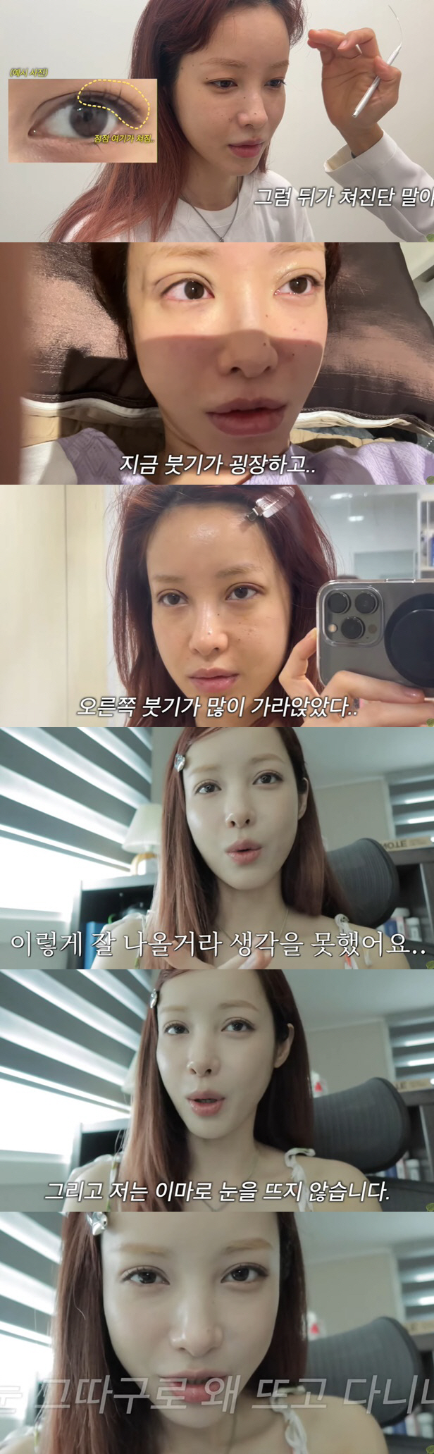 '가슴·윤곽 성형' 유깻잎, 쌍꺼풀 수술도 받았다 "이제 이마로 눈 안 …
