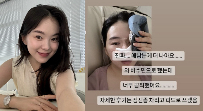 하늘, 출산 두 달만 코 재수술 "비수면 끔찍, 애 낳는 게 나아"