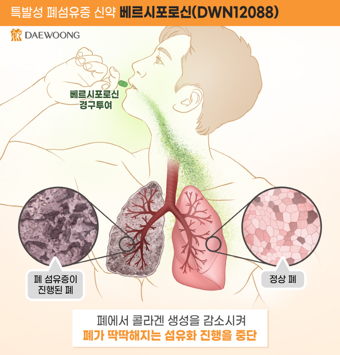 대웅제약 "특발성 폐섬유증 치료제 임상 2상, 2차 IDMC 회의서도 안…