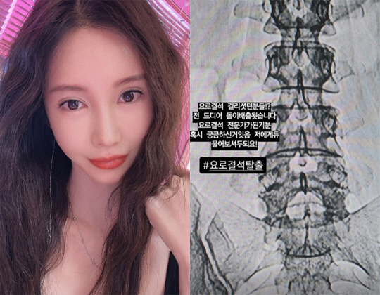 '병원行' 신주아, 죽다 살아났다 "드디어 돌 배출..요로결석 탈출"