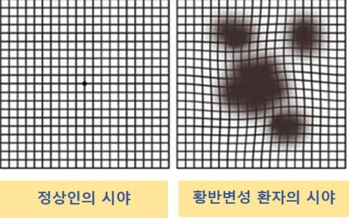 '혹시 이렇게 보이나요?' 실명 유발 '황반변성' 의심 증상