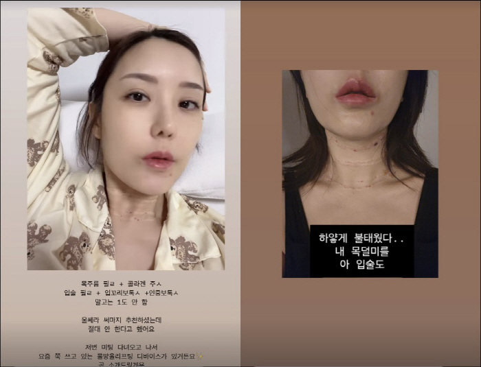 '돌싱3' 이소라, 코 필러 부작용에도 목주름·입술 필러 시술 "하얗게 …