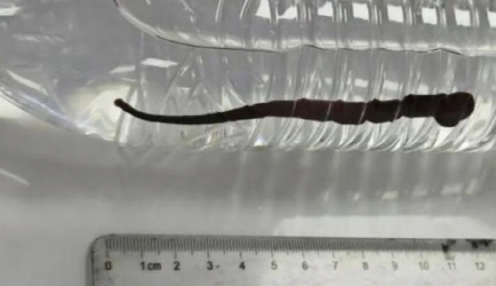 7세 아이 심한 기침하더니 토한 검은 물체 꿈틀 '경악'