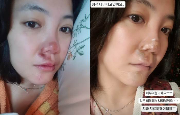 고은아, 코 재수술했는데..얼굴 크게 다쳤다 "빙판길에 넘여져"