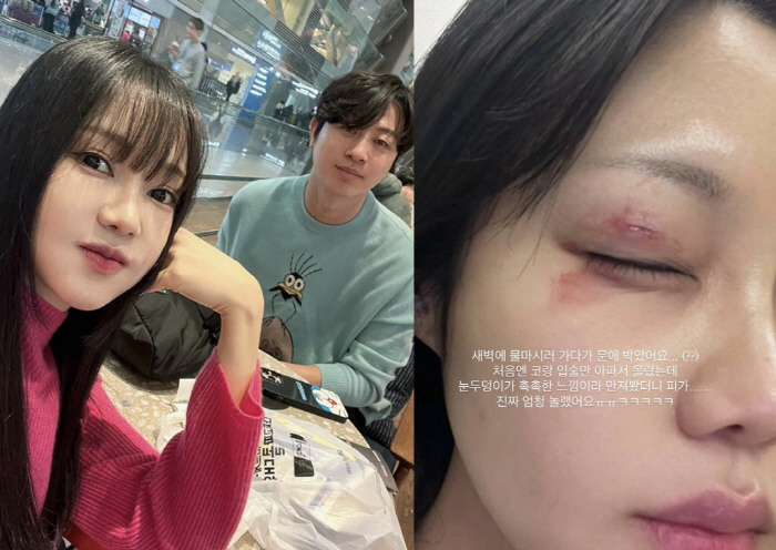 '♥유상무' 김연지, 퉁퉁 붓고 피까지..심각한 얼굴 부상 "맞았냐는 소…