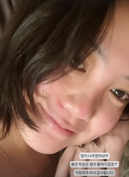 [SCin스타] 고은아, 코 재수술 절대 지켜..빙판길 낙상사고→안면부상…