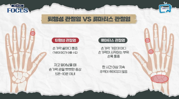[류마티스 관절염 Q&A] 여성 발생률 최고 5배 높아…치료와 생활수칙은…