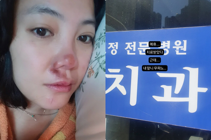 '코 재수술 중형차값' 고은아, 심각한 얼굴부상에 병원行 내 "앞니 우짜…