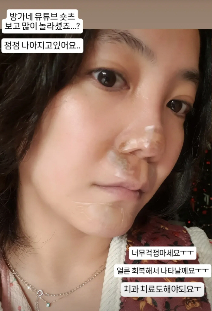 '코 재수술 중형차값' 고은아, 심각한 얼굴부상에 병원行 내 "앞니 우짜…