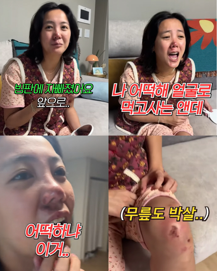 '코 재수술 중형차값' 고은아, 심각한 얼굴부상에 병원行 내 "앞니 우짜…