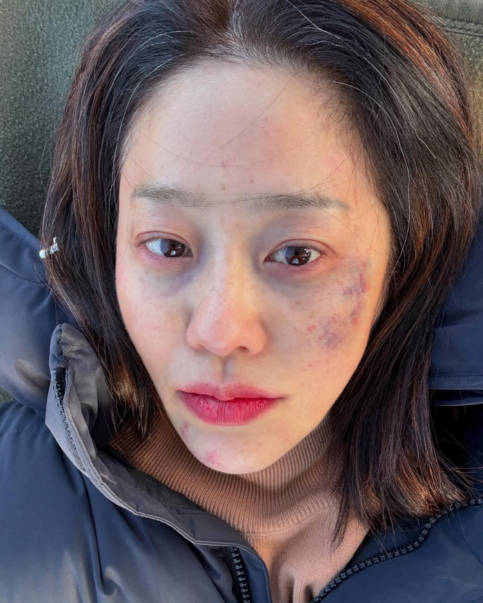 고현정, 멍투성이 얼굴 '충격'...'사마귀' 촬영장서 무슨일이