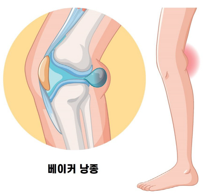 무릎 뒤쪽에 물혹 '베이커 낭종', 어떤 질환이길래?