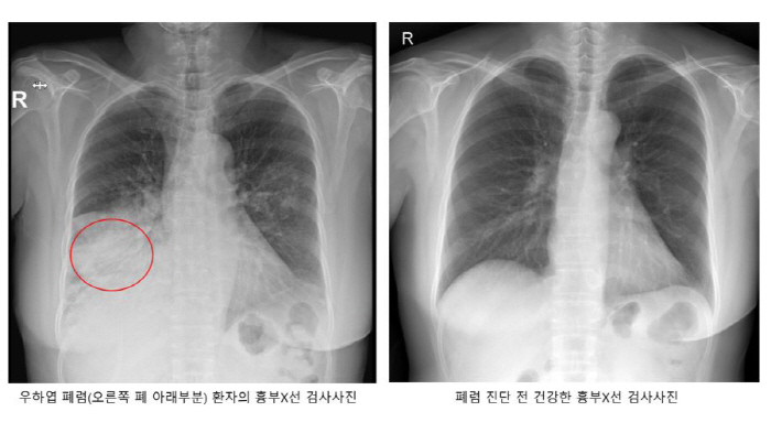 감기와 증상 비슷한 폐렴, 입술 푸른빛 돌면 '위험'