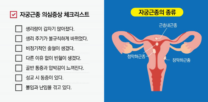 4년간 46% 증가한 '자궁근종', 방치 땐 불임·임신 합병증 위험