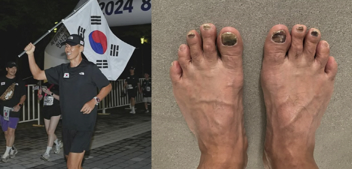 션, 마리톤 도전 앞두고 안타까운 소식 전했다 "양쪽 발톱 3개씩 총 6…