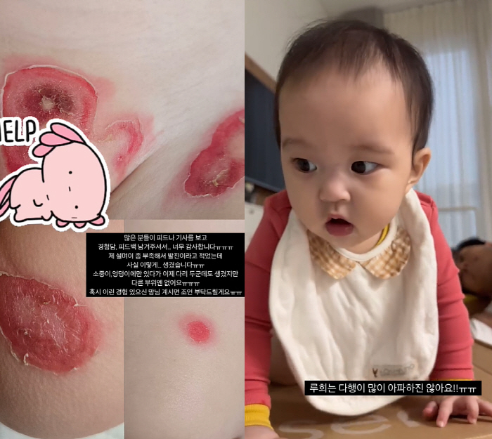 '이지훈♥' 아야네 8개월 딸, 온 몸 빨간 발진 어쩌나...긴급 SOS…