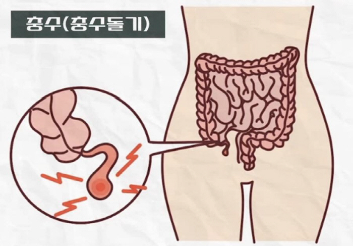 [충수염 Q&A] 발병 2일 내 70~80%에서 천공 발생…오른쪽 다리 …