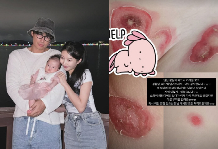 이지훈♥아야네, 딸 원인불명 질환에 결국 오열..충격 피부 상태