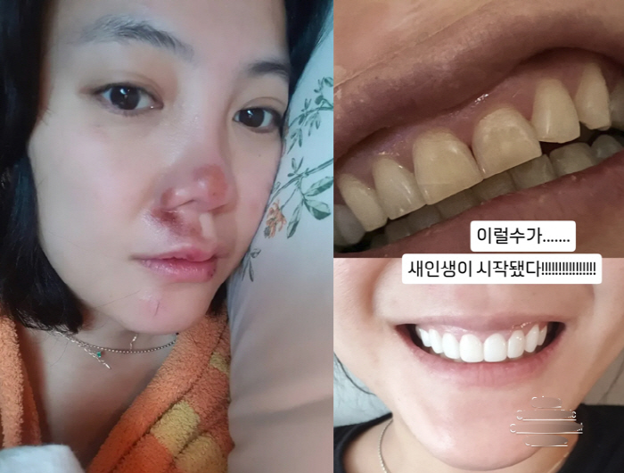 고은아, 심각한 안면부상 치료 후 얼굴 확 달라졌다..."새 인생 시작"