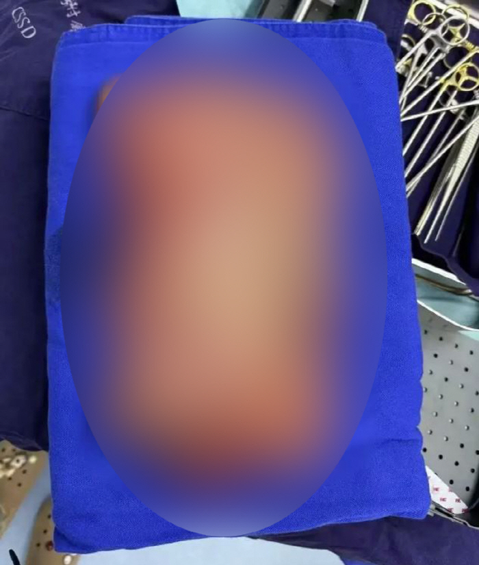 과식하던 여성, 위에서 소화 안 된 음식 5kg 제거…괴사·천공도 발견