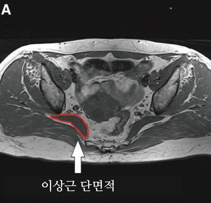 허리디스크와 헷갈리는 '이상근 증후군' 새 진단 기준 제시