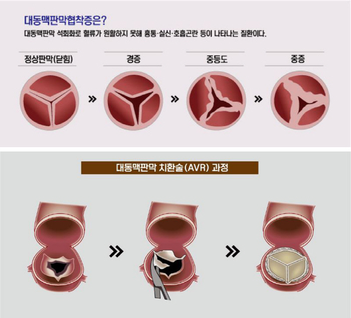 부모님 가슴 통증에 호흡곤란?…돌연사 위험 '이 질환' 의심