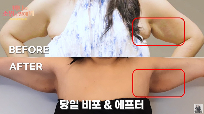 '미나 시누이' 수지, '60kg 감량+시술' 후 사라진 팔뚝살+턱살 비…
